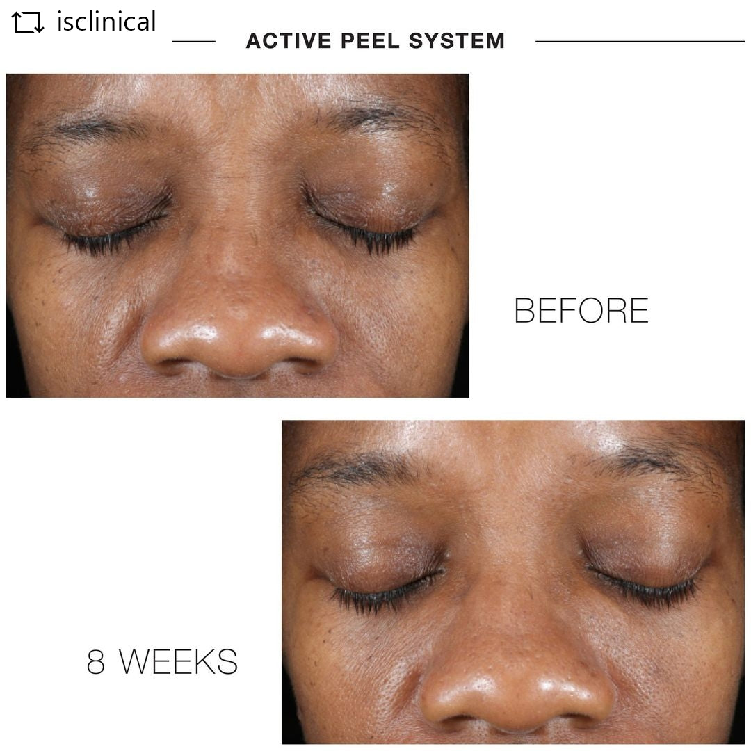 ACTIVE PEEL SYSTEM
