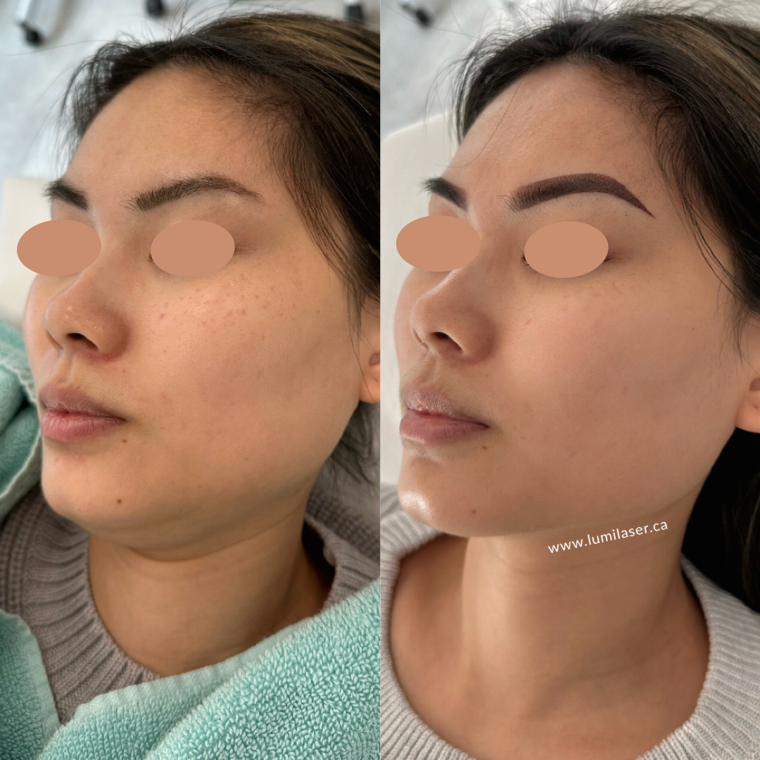 Laser Skin Brightening Treatments in Montreal, Quebec - Lumilaser Esthetics