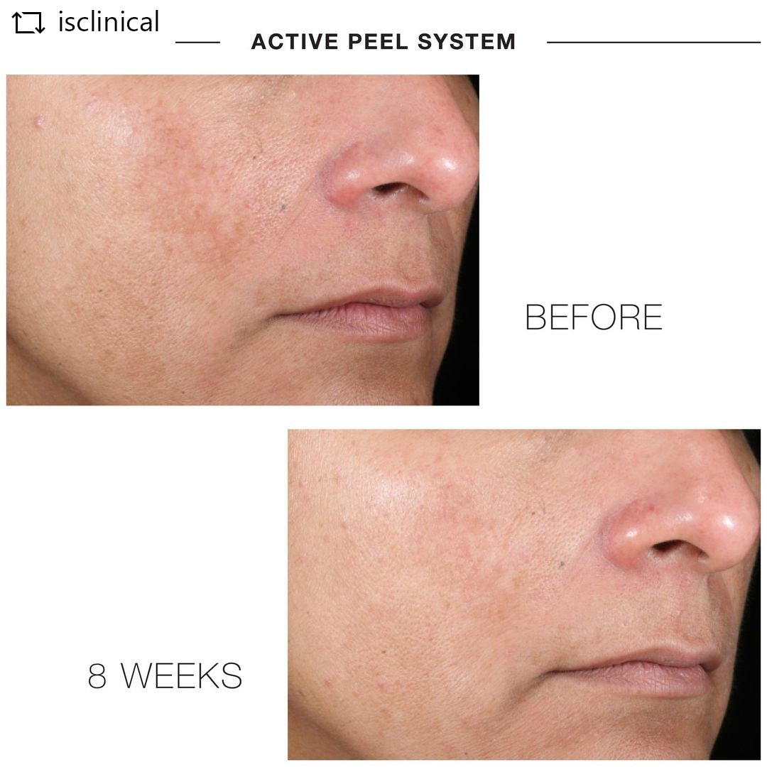 ACTIVE PEEL SYSTEM