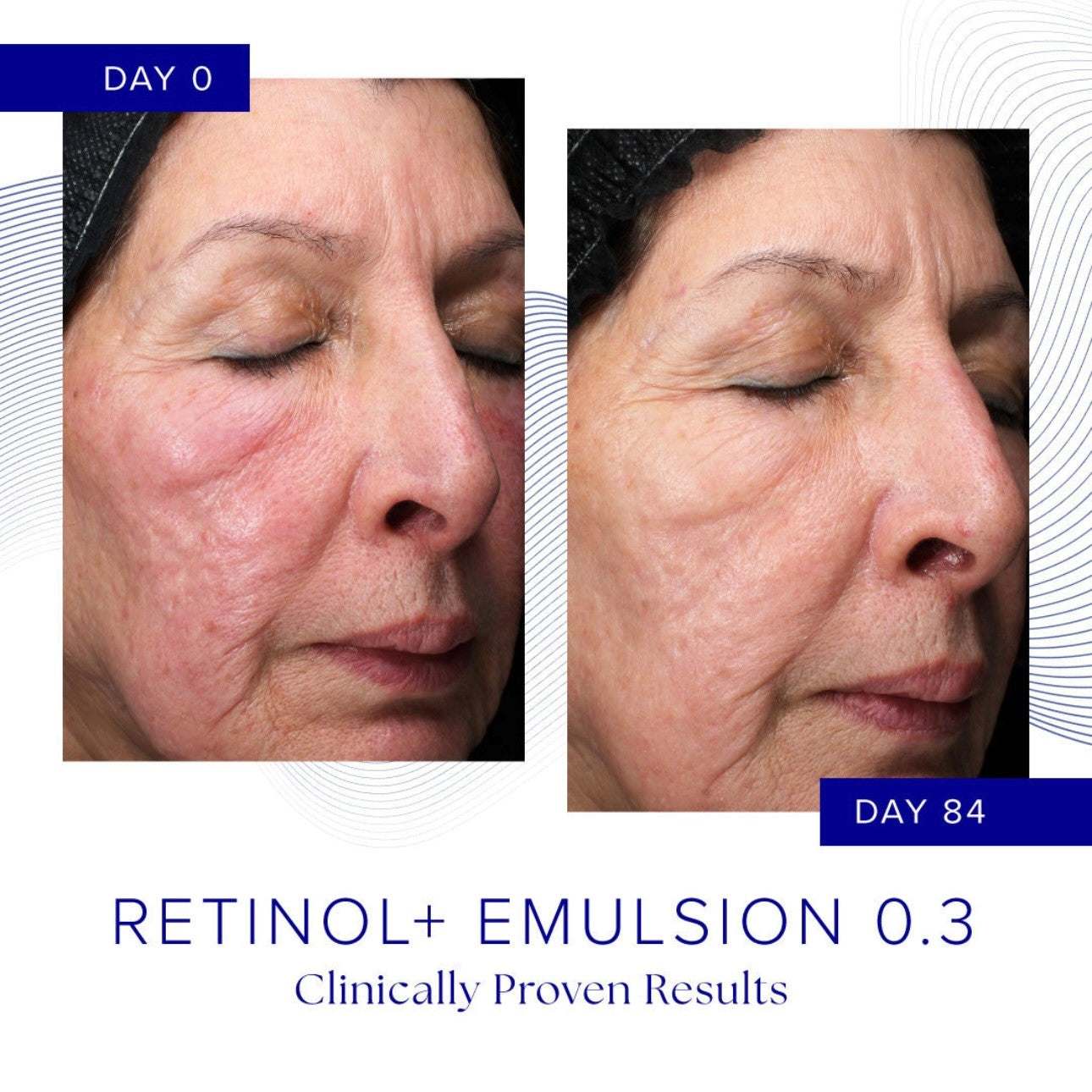 RETINOL+ EMULSION 0.3%