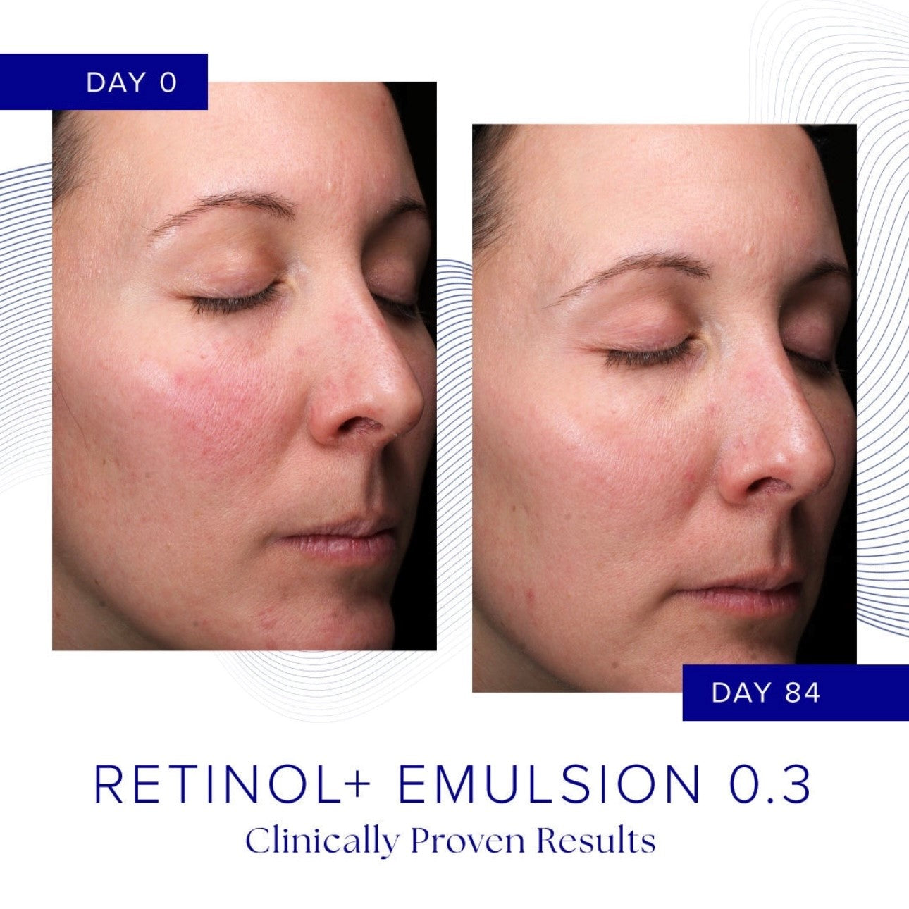 RETINOL+ EMULSION 0.3%