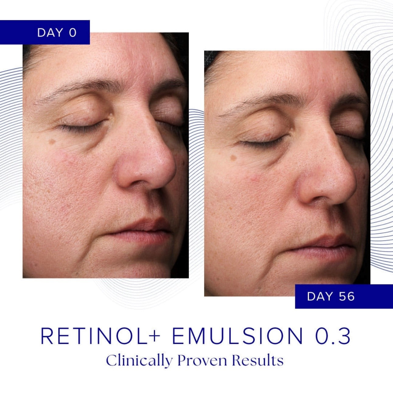 RETINOL+ EMULSION 0.3%