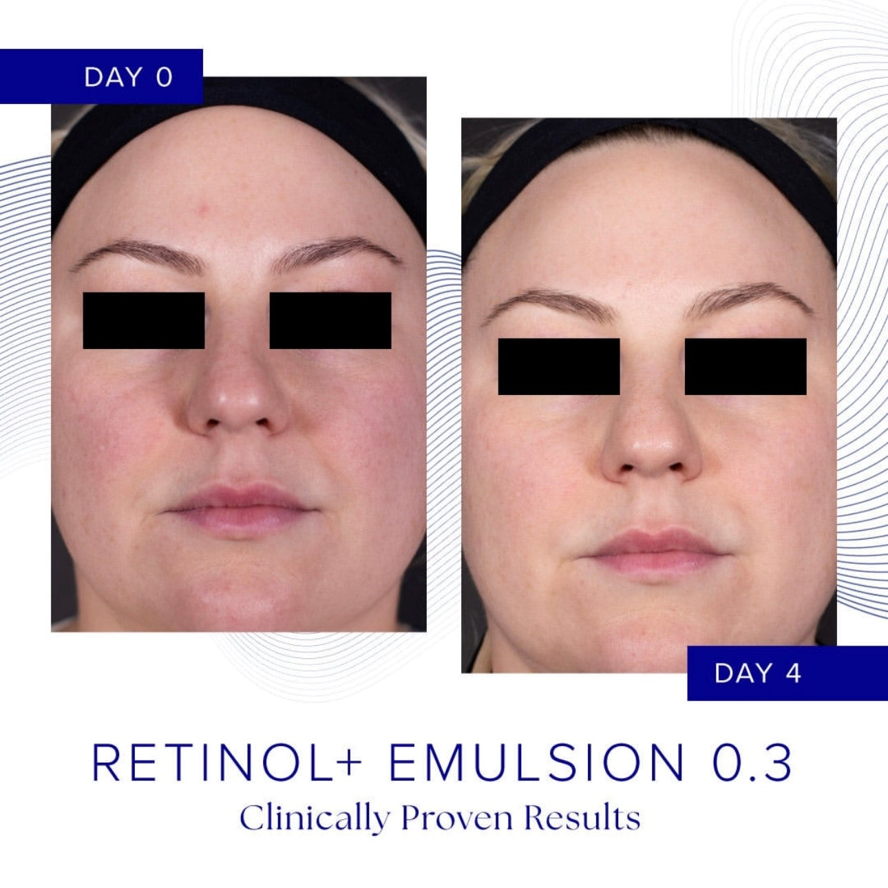 RETINOL+ EMULSION 0.3%