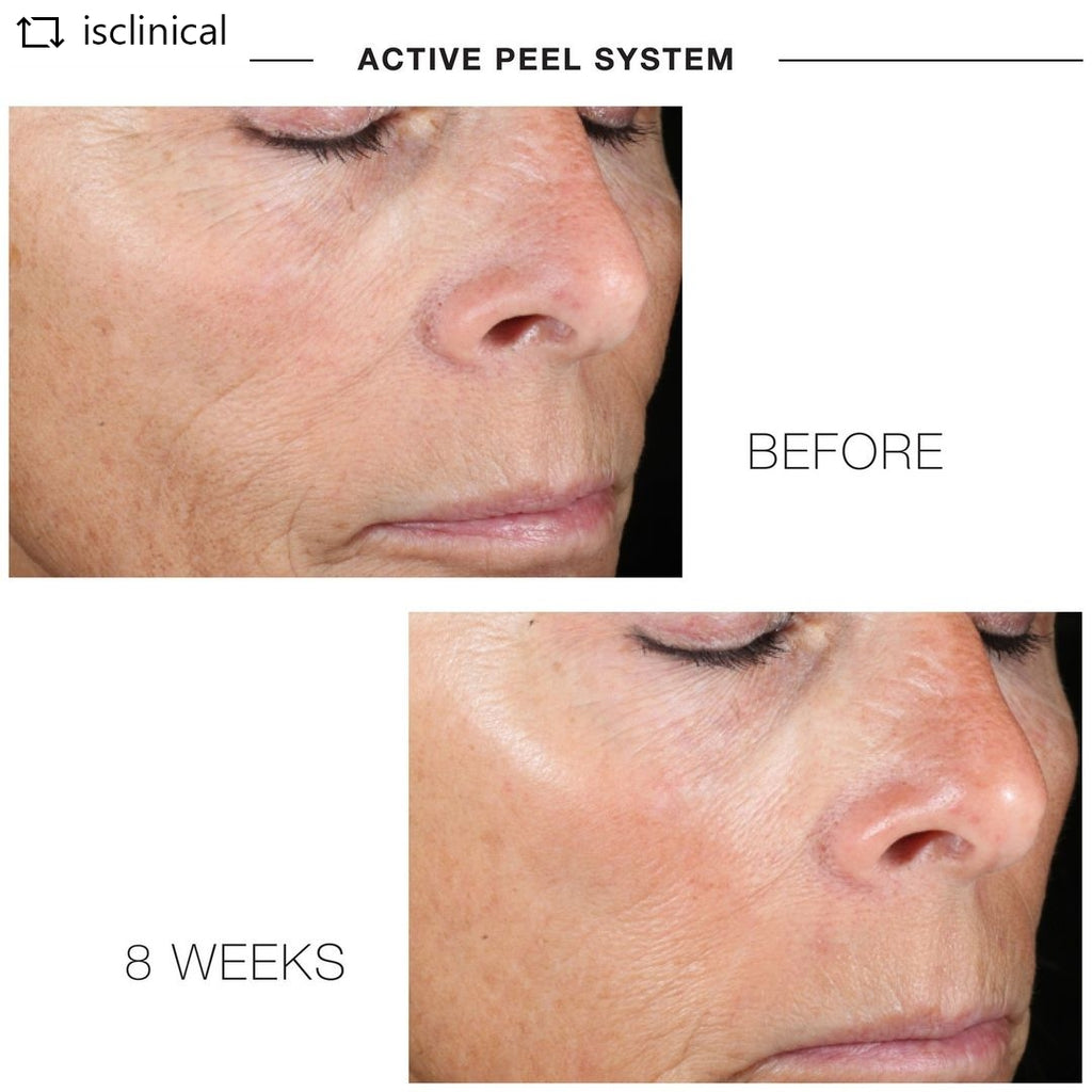 ACTIVE PEEL SYSTEM