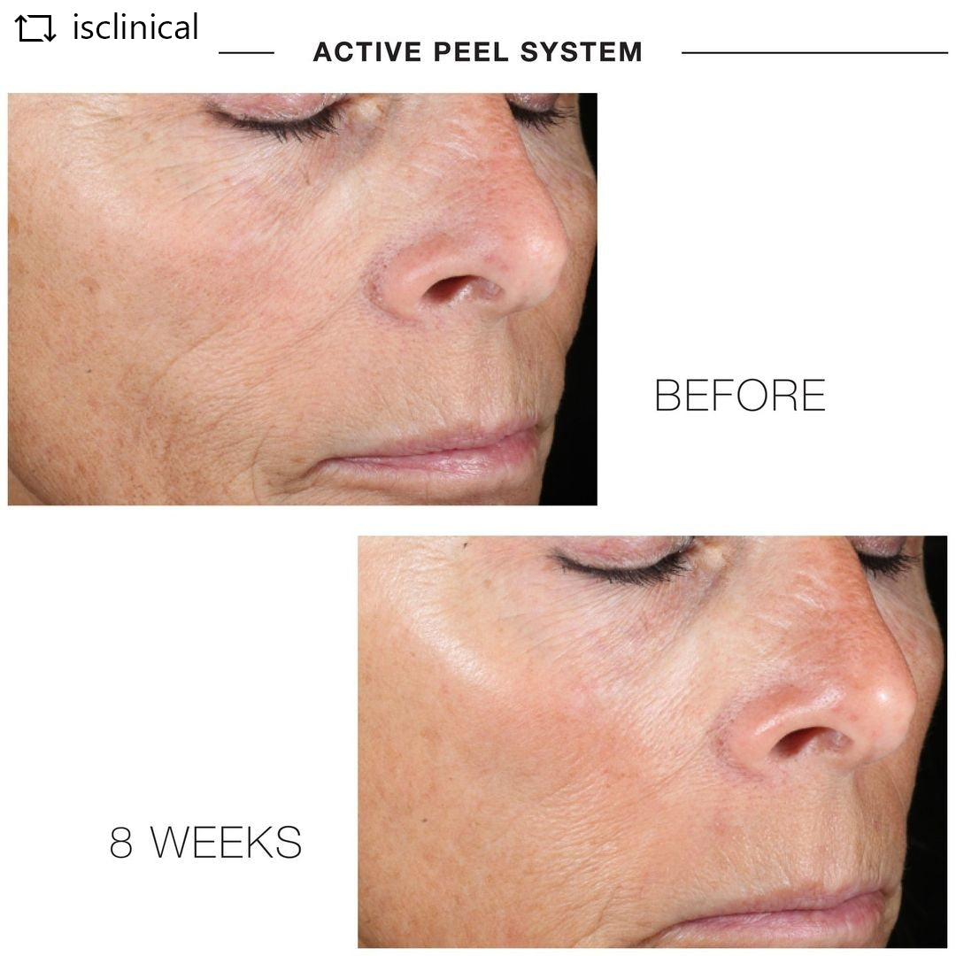 ACTIVE PEEL SYSTEM